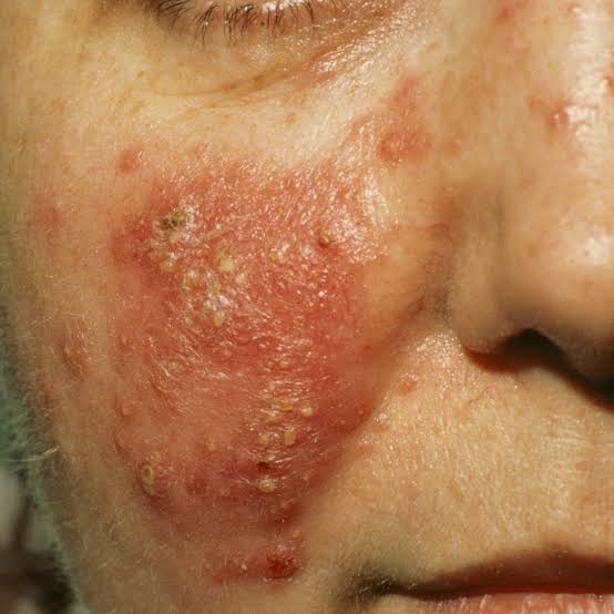 Allergy