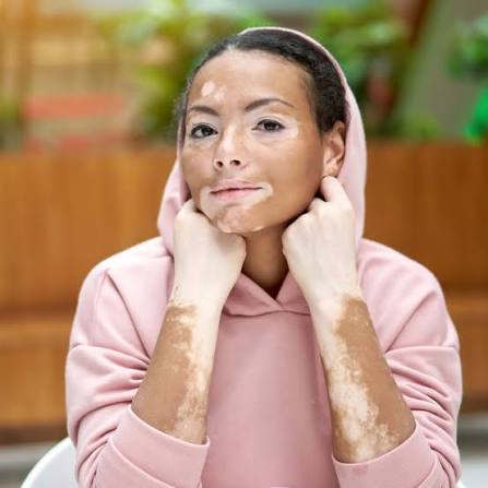 Leucoderma / Vitiligo Care