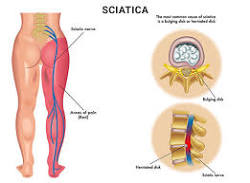 Sciatica